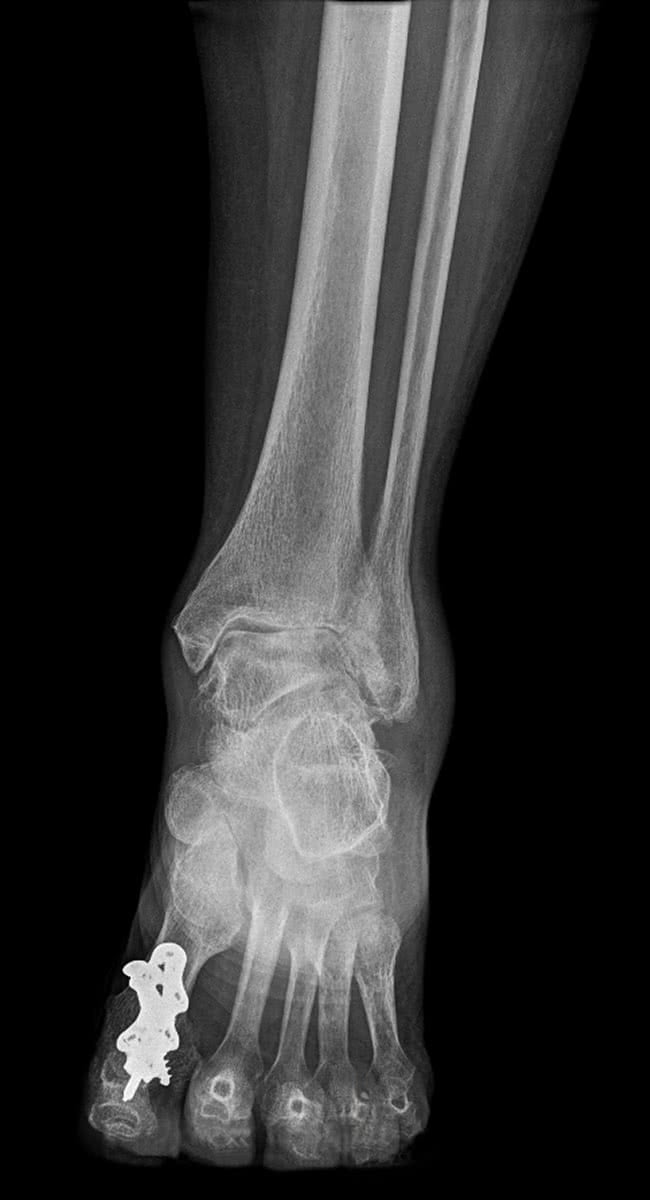 Mr Miles Callahan | Ankle Arthritis