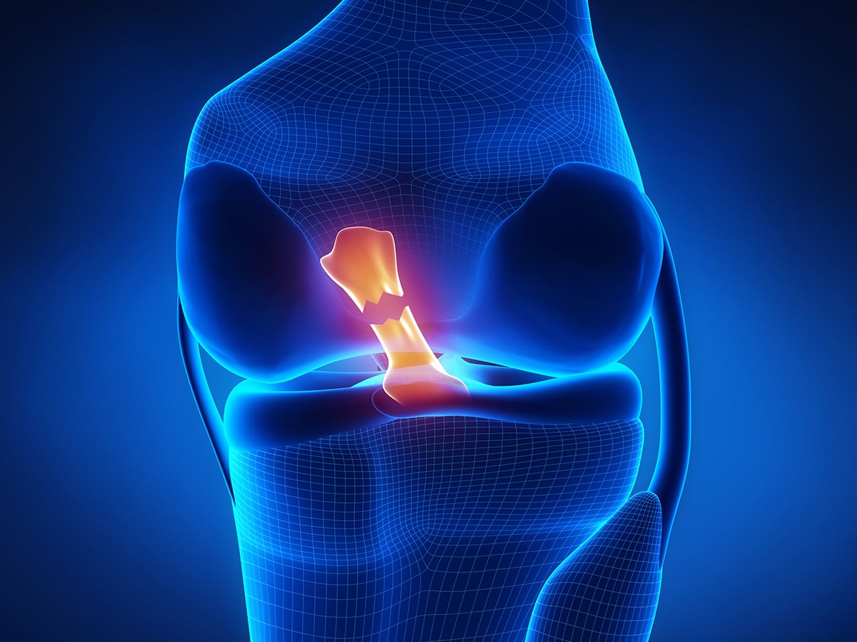 Mr Miles Callahan Anterior Cruciate Ligament Reconstruction