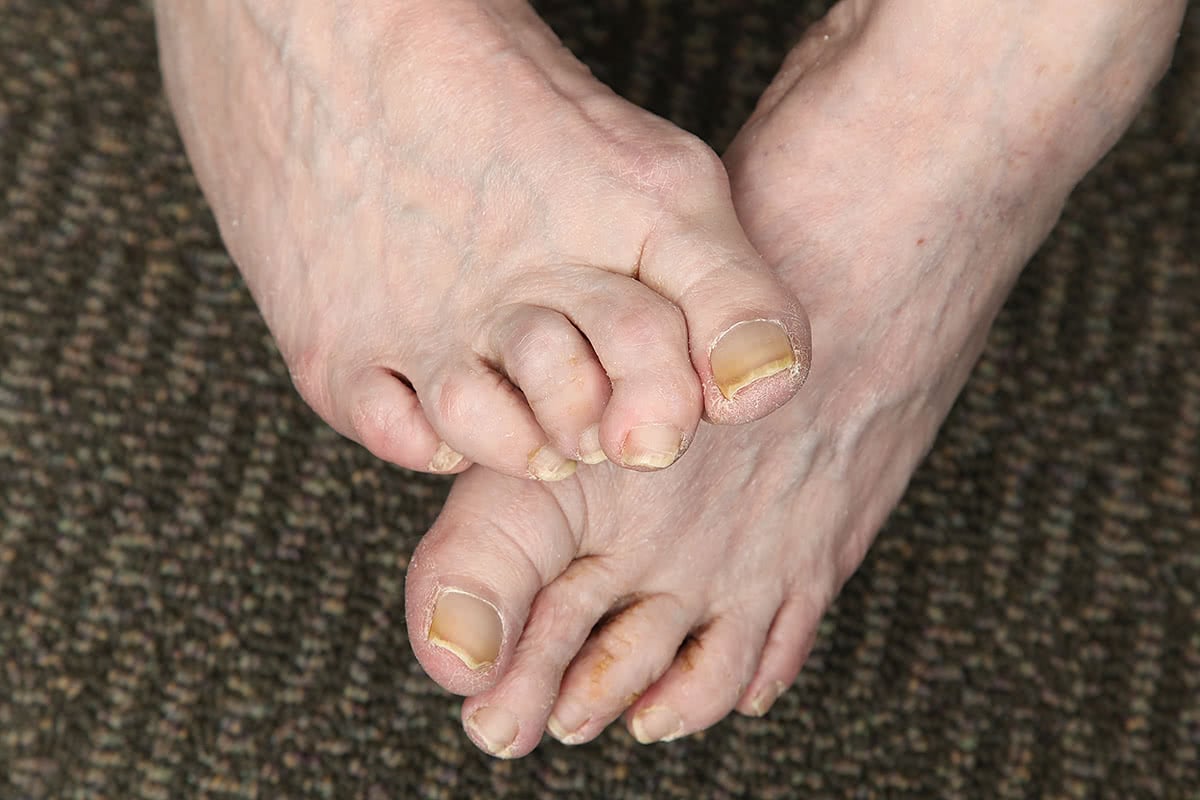https://milescallahan.com.au/sites/default/files/claw-and-hammer-toes-1.jpg