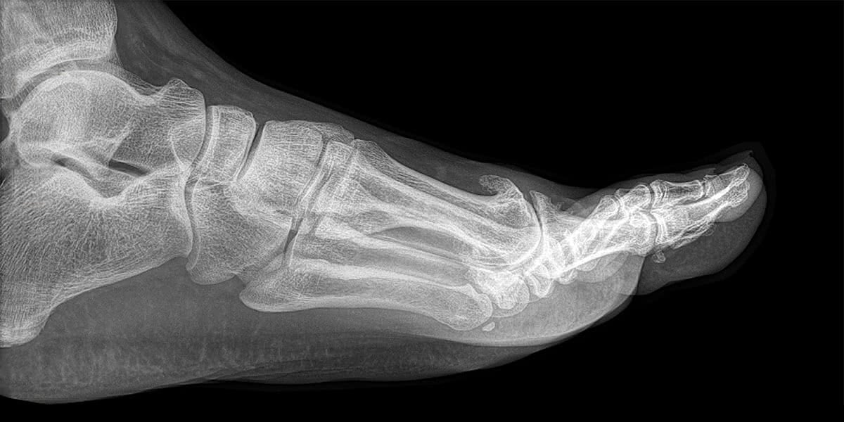 Mr Miles Callahan | Hallux Rigidus (Arthritic big toe)
